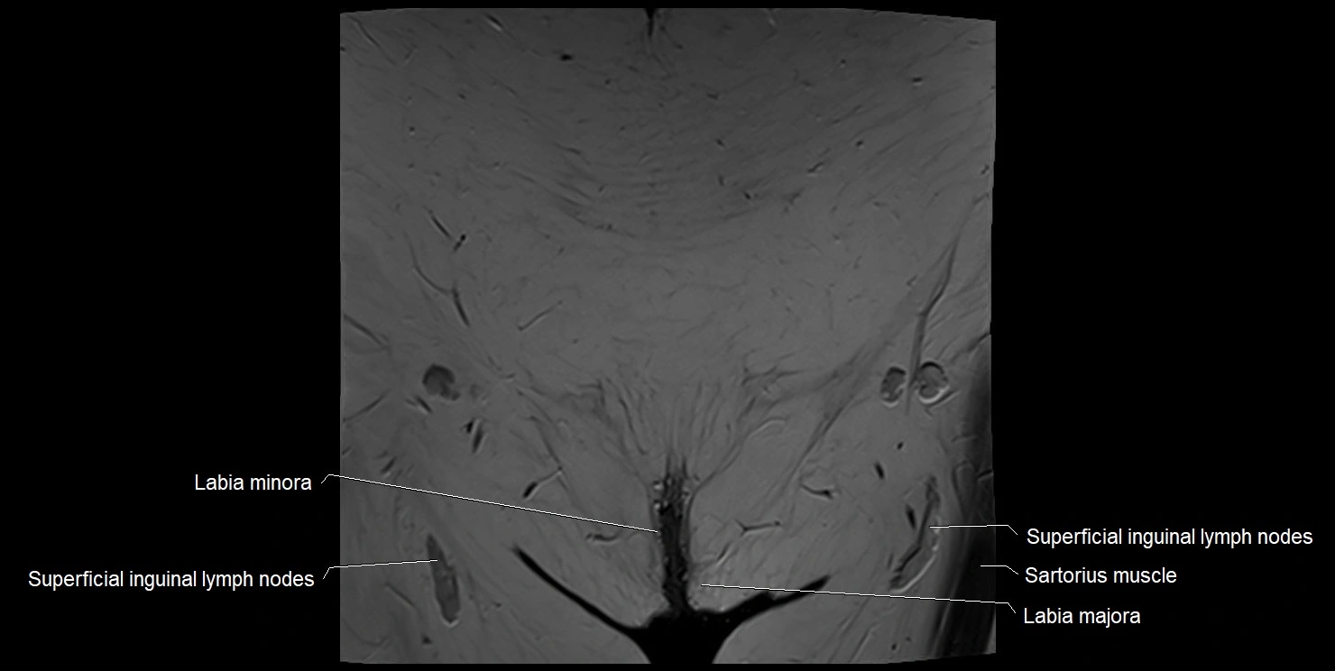 female pelvis coronal cross sectional anatomy image 1.webp